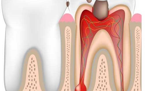 عفونت ریشه دندان و راه های درمان آن