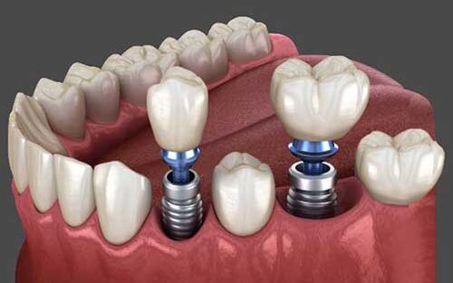 مزایای ایمپلنت دندان و نحوه انجام آن در مطب دندانپزشکی