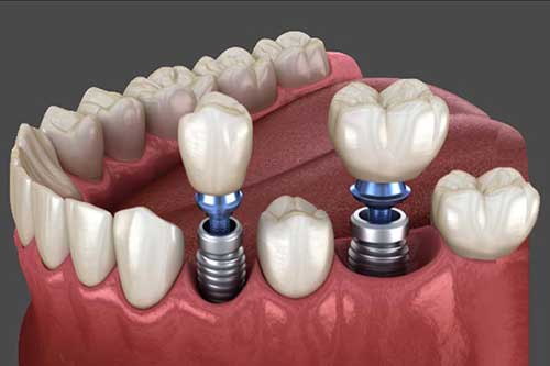 مزایای ایمپلنت دندان و نحوه انجام آن در مطب دندانپزشکی