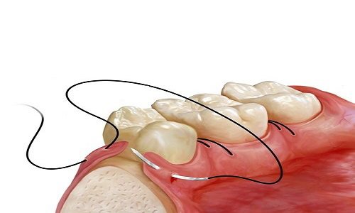 کشیدن بخیه دندان
