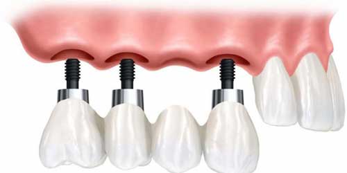 ایمپلنت های دندانی در مقابل بریج